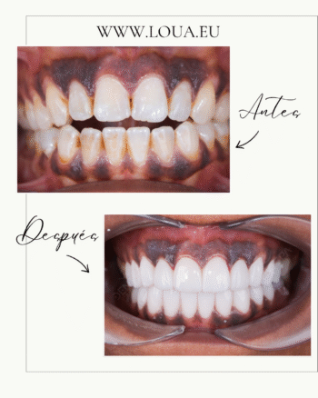 Resultados reales de cirugía plástica en Turquía con equipo médico especializado