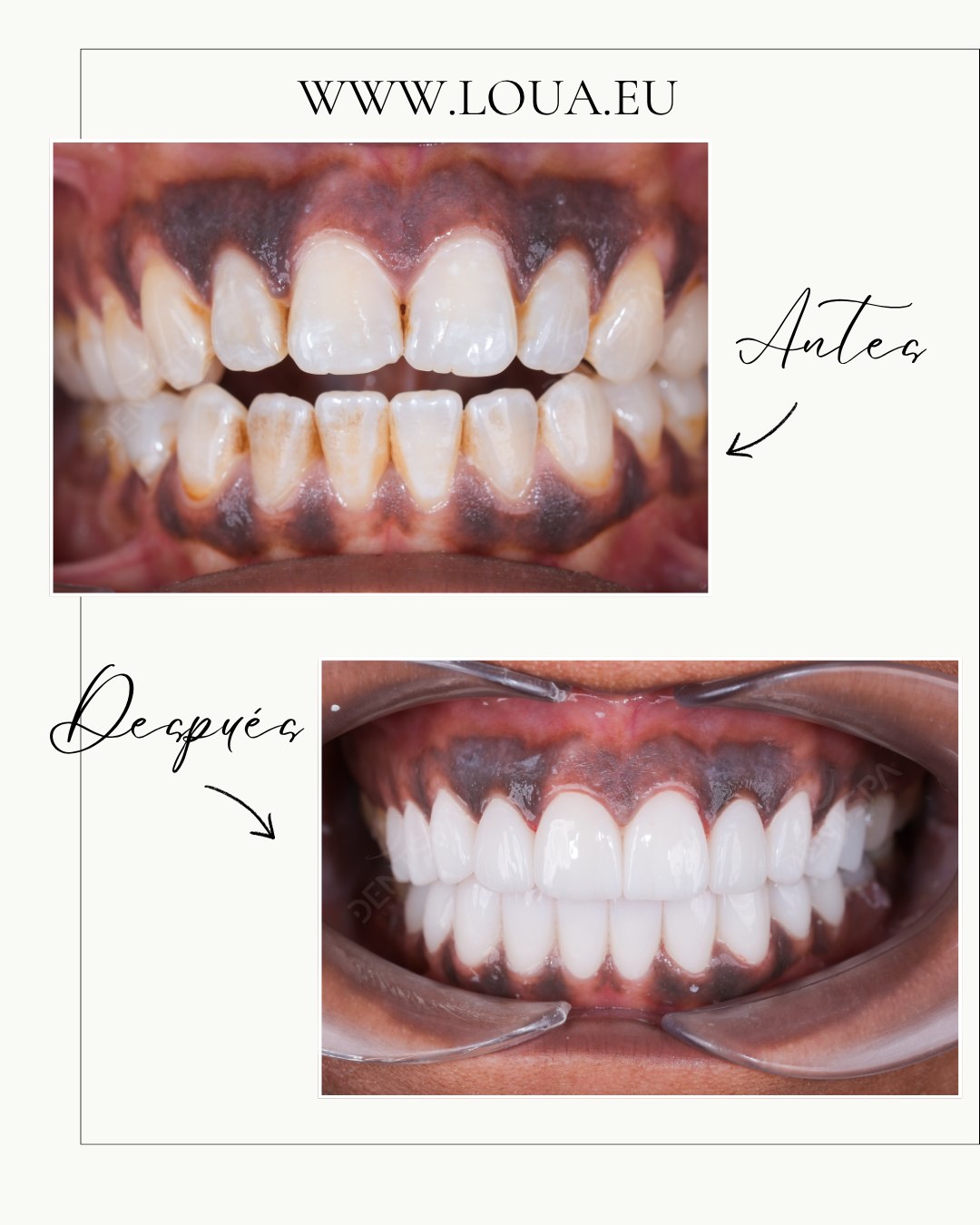 Implantes Dentales Resultados reales de cirugía plástica en Turquía con equipo médico especializado