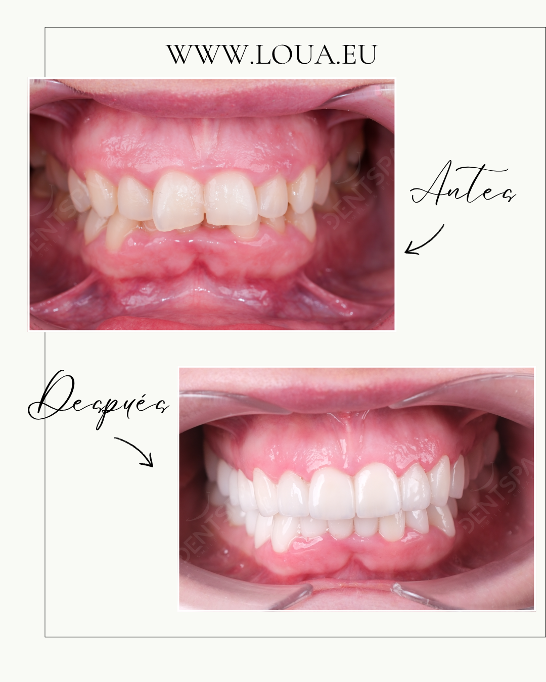 Implantes Dentales Resultados reales de cirugía plástica en Turquía con equipo médico especializado