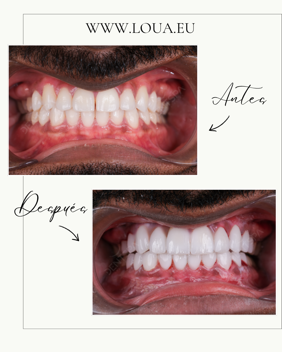 Carillas Dentales Resultados reales de cirugía plástica en Turquía con equipo médico especializado