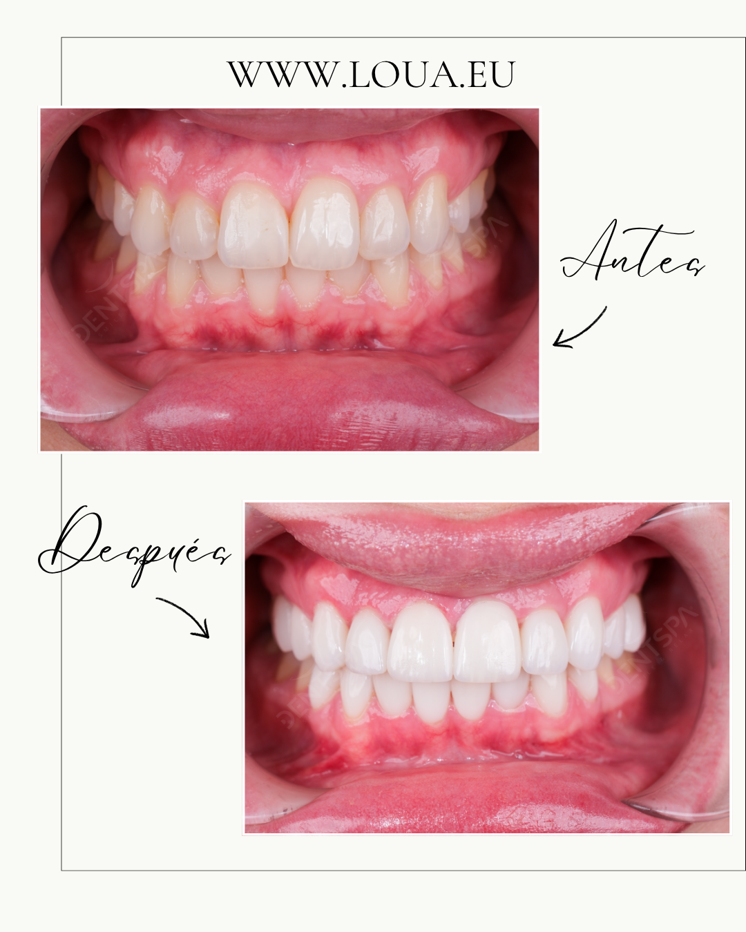 Implantes Dentales Resultados reales de cirugía plástica en Turquía con equipo médico especializado
