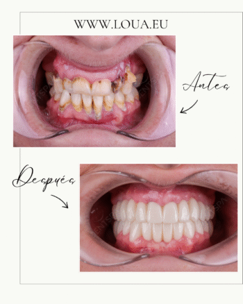 Resultados reales de cirugía plástica en Turquía con equipo médico especializado
