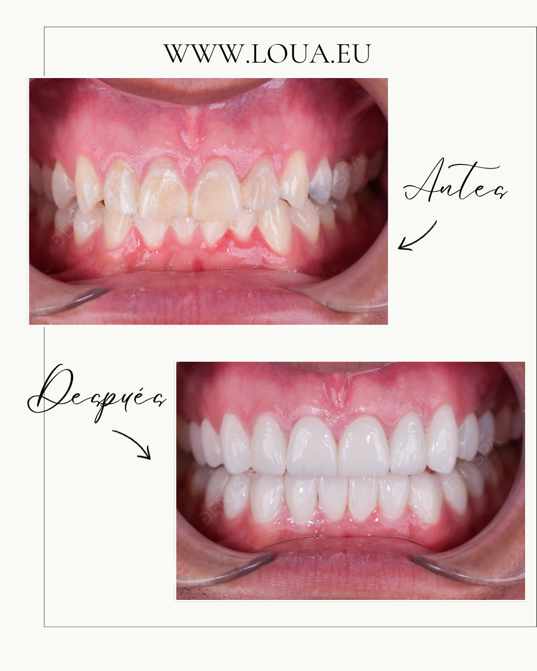 Implantes Dentales Resultados reales de cirugía plástica en Turquía con equipo médico especializado