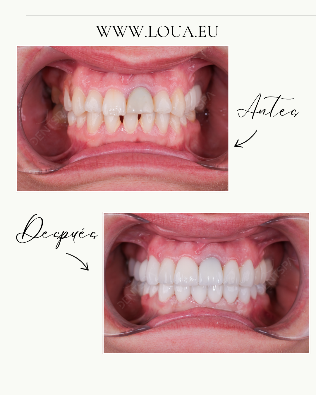 Implantes Dentales Resultados reales de cirugía plástica en Turquía con equipo médico especializado