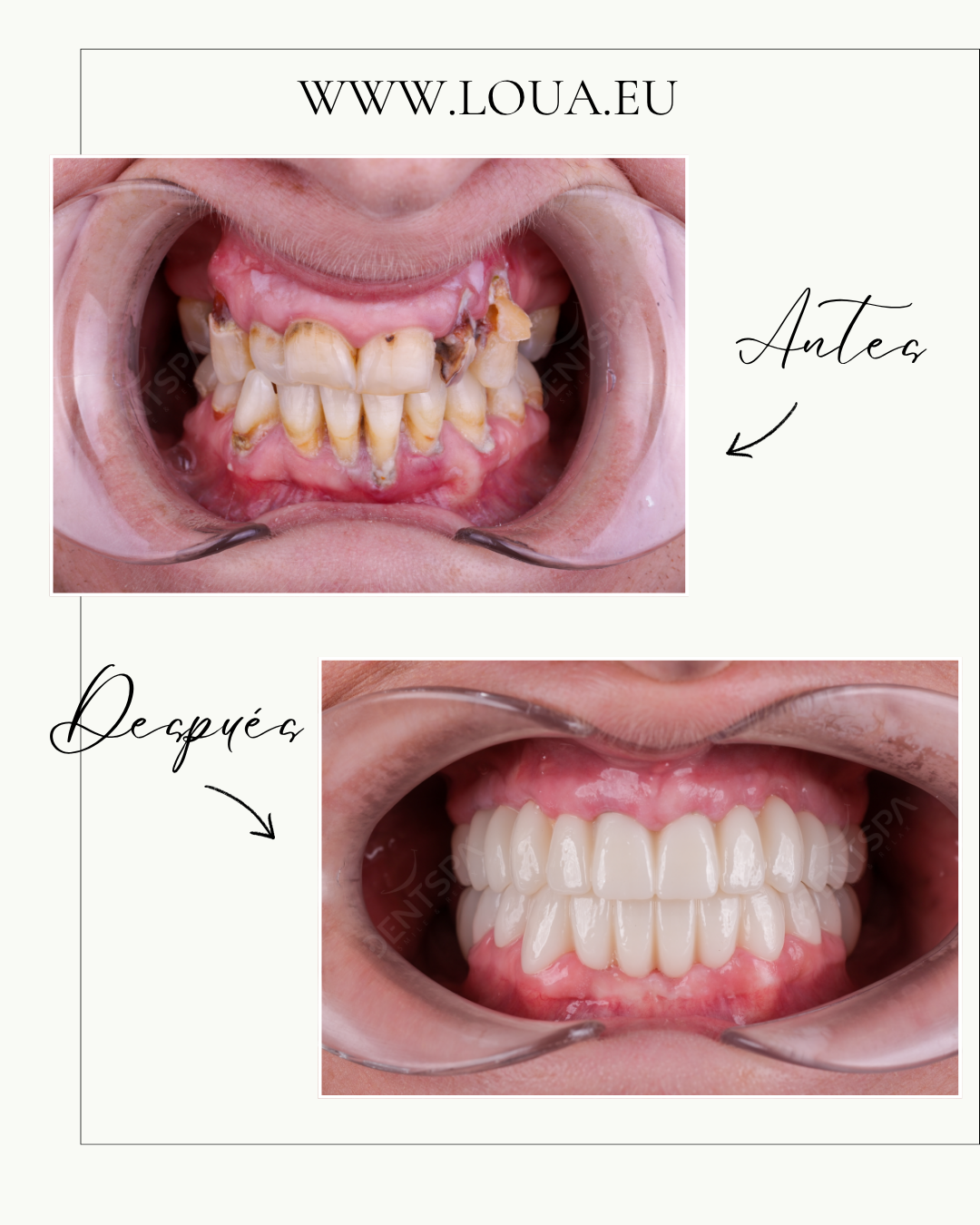 Carillas Dentales Resultados reales de cirugía plástica en Turquía con equipo médico especializado