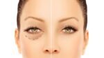 Blefaroplastia