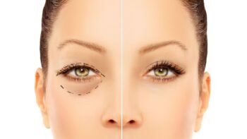 Blefaroplastia