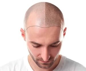 Microinjerto capilar con especialistas acreditados en clínica de Estambul, Turquía con acompañamiento VIP