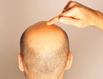 Microinjerto capilar con especialistas acreditados en clínica de Estambul, Turquía con acompañamiento VIP