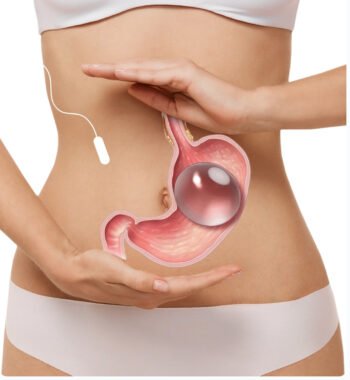 Balón gástrico con técnica avanzada en clínica acreditada en Turquía con acompañamiento VIP y logística completa