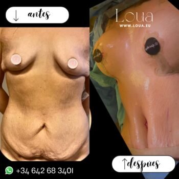 Resultados reales de cirugía plástica corporal post embarazo con técnica avanzada realizados por especialistas acreditados en Turquía. Con acompañamiento VIP y seguimiento médico completo y resultados naturales.